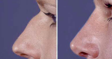 عمليات تجميل الأنف لها آثار نفسية سلبية ضارة