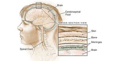 ارتفاع عدد وفيات الالتهاب السحائى فى أمريكا إلى 15 شخصا