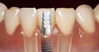 زراعه الأسنان ثورة جديدة فى عالم تجميل الأسنان