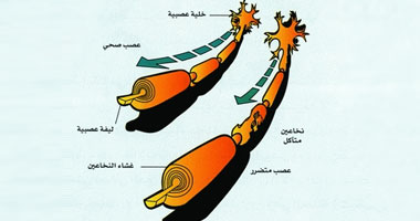 دراسة: مرضى التصلب العصبى أكثر عرضة للإصابة بالسرطان
