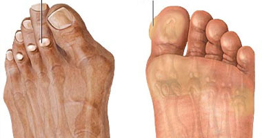 ما الفرق بين عين السمكة وشوكة القدم؟