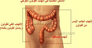 من غير ما تقلق .. اعرف أسباب النزيف الشرجى
